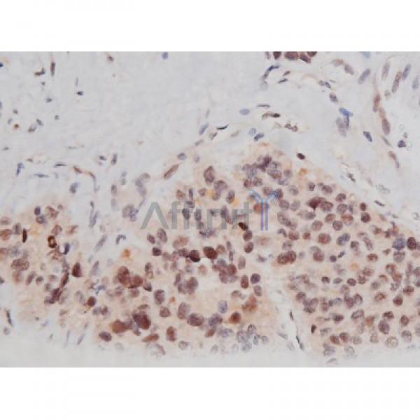 Phospho-Tau (Thr181)[Thr498] Antibody - AF3149 at 1/200 staining Human liver cancer tissue sections by IHC-P.